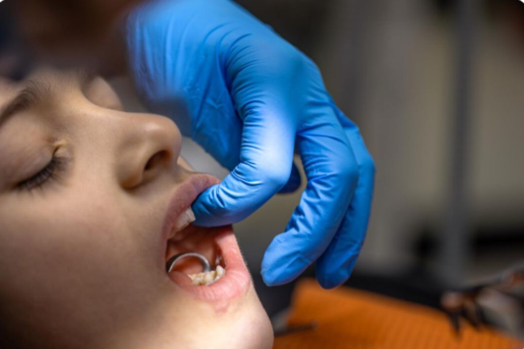 "Metal dental crown being prepared and placed on a tooth by a dentist"